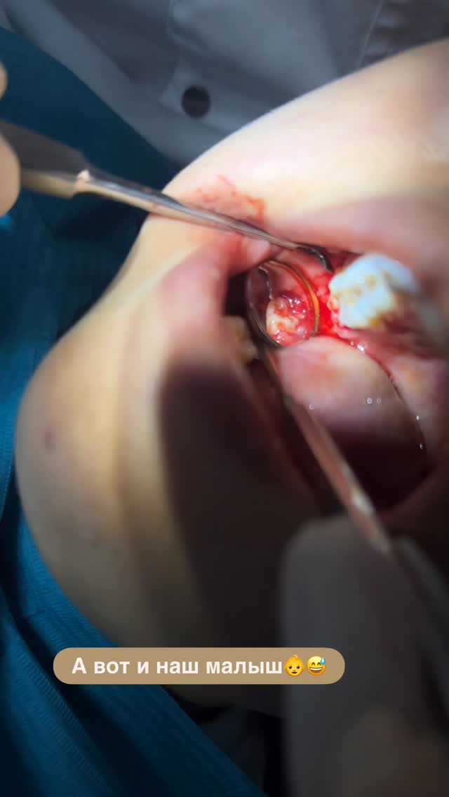 Лечение пульпита