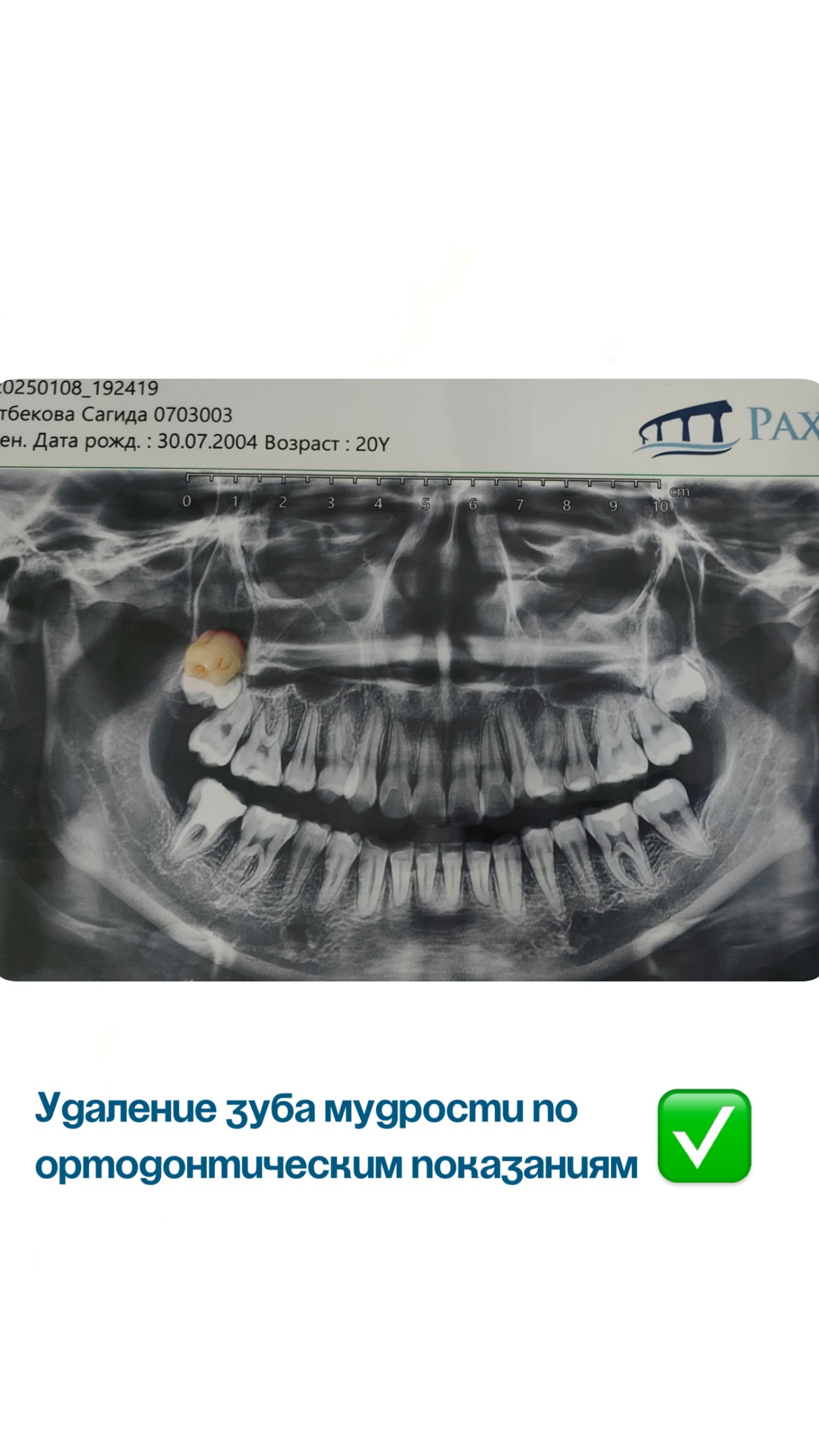 Мостовидный протез