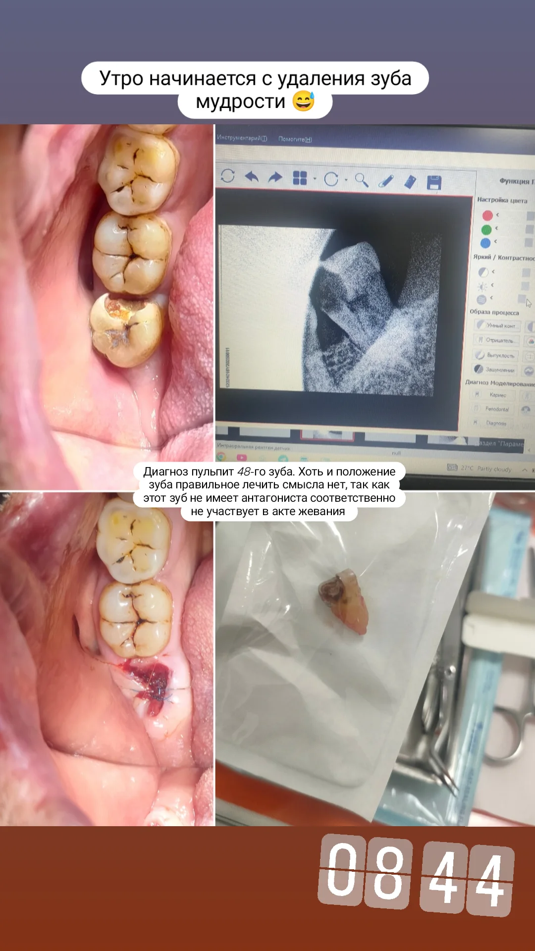 Профессиональная чистка зубов