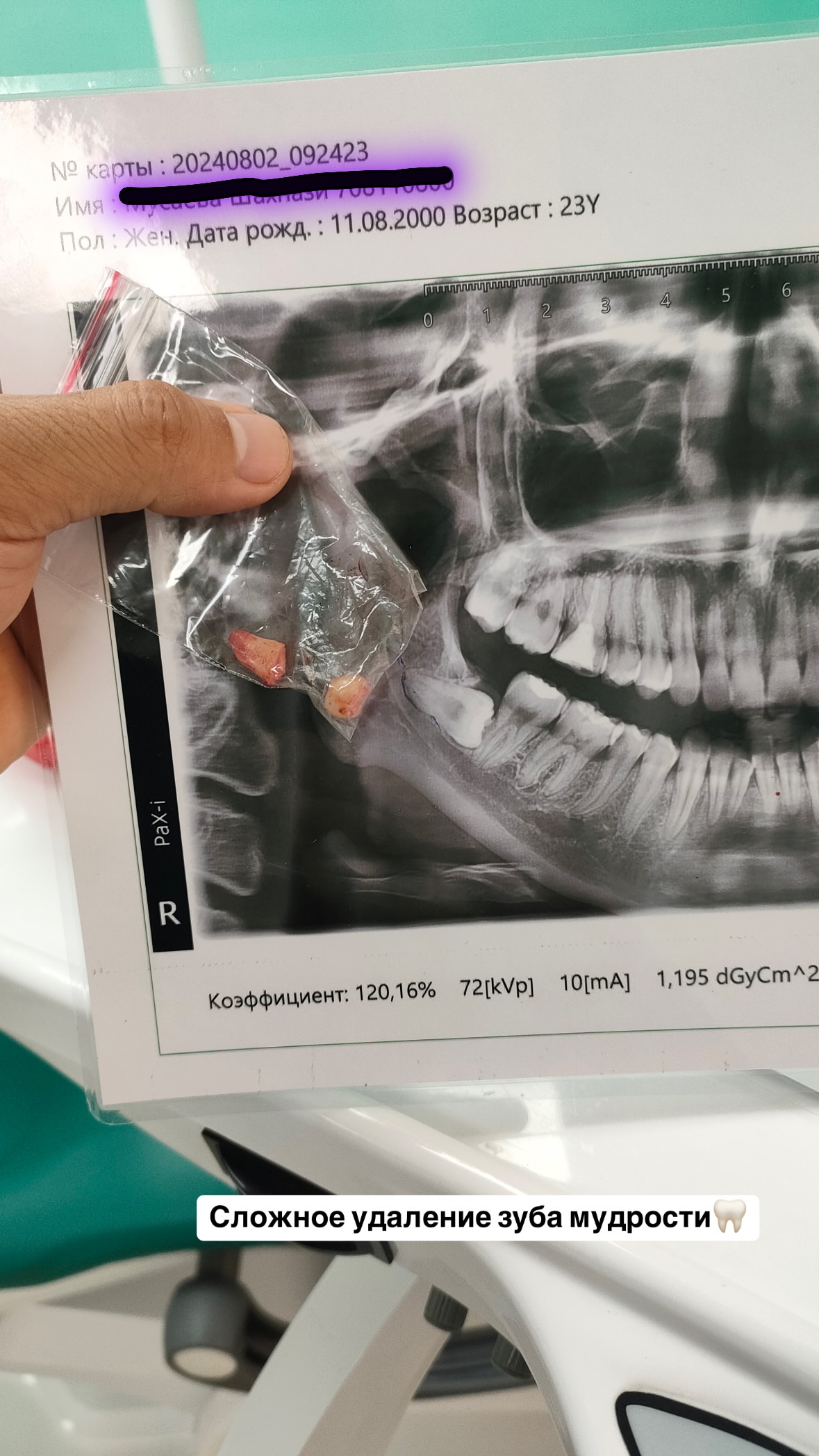 Удаление ретинированных зубов мудрости