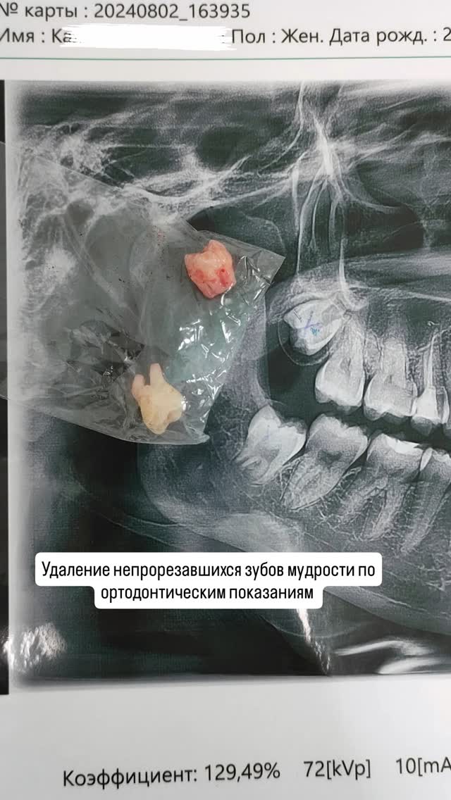 Удаление зубов мудрости