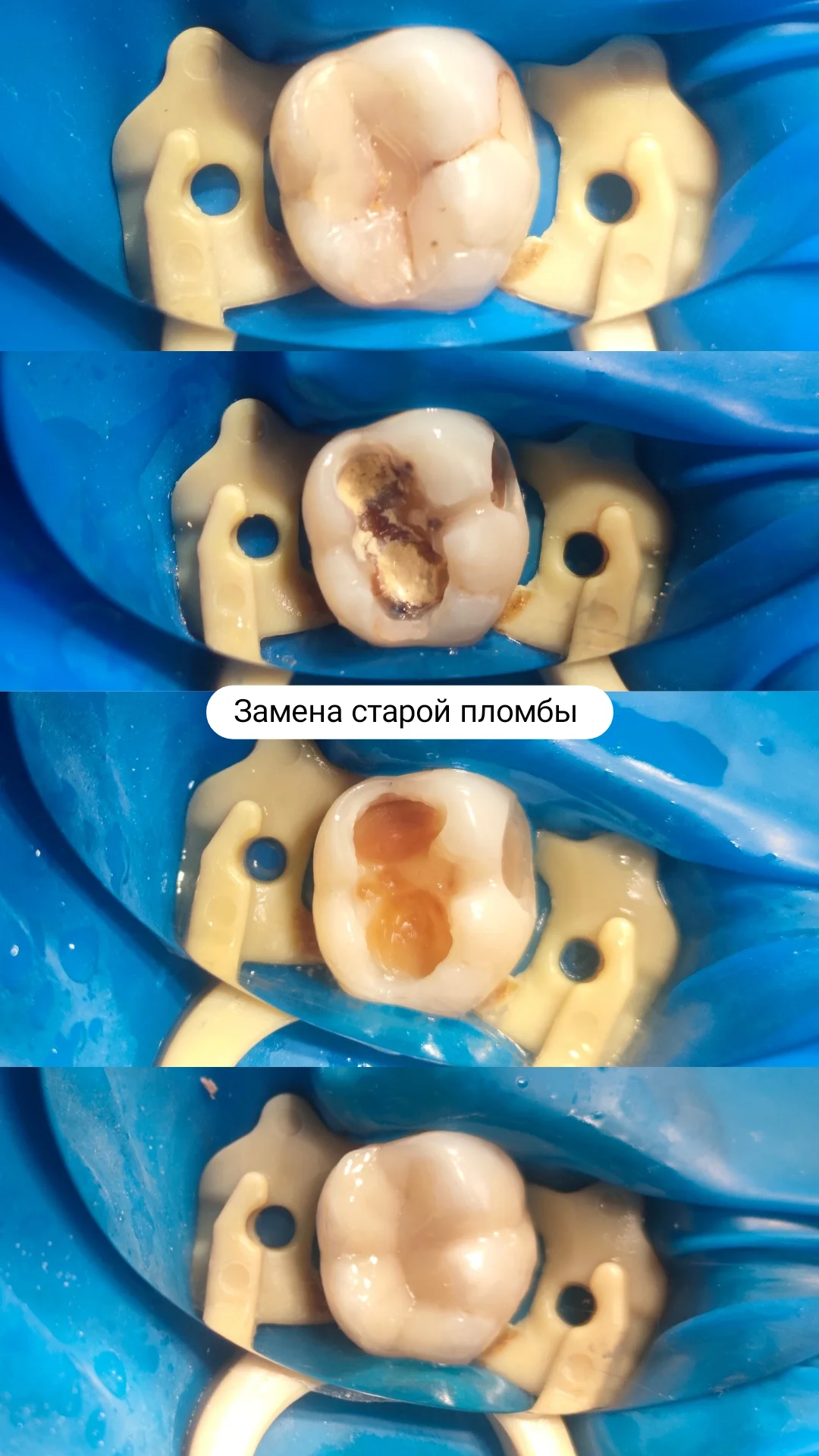 После лечения кариеса