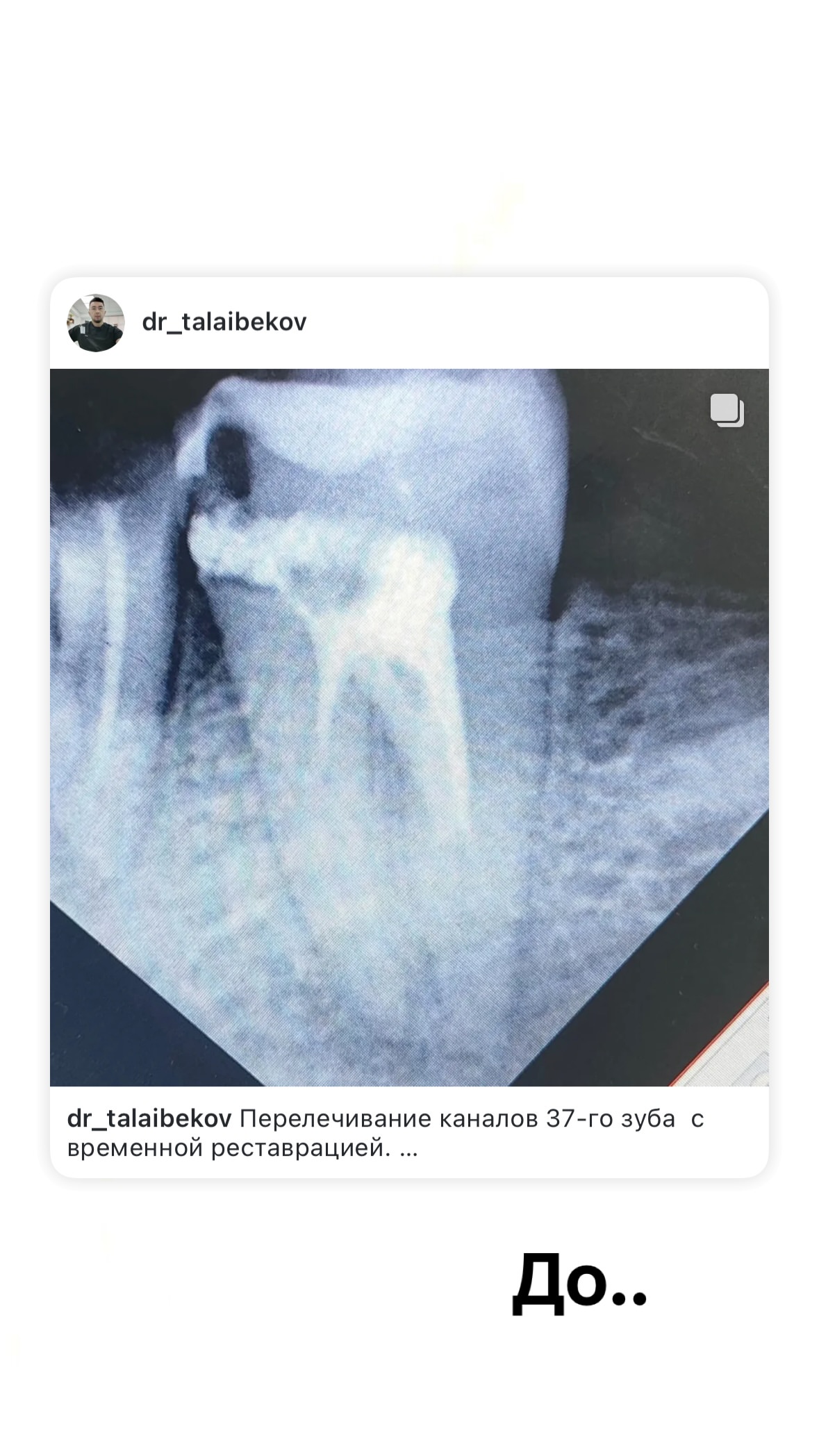 Эндодонтическое лечение