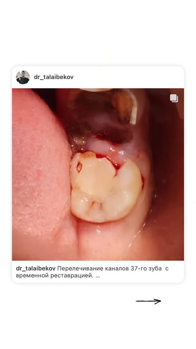 Перелечивание каналов