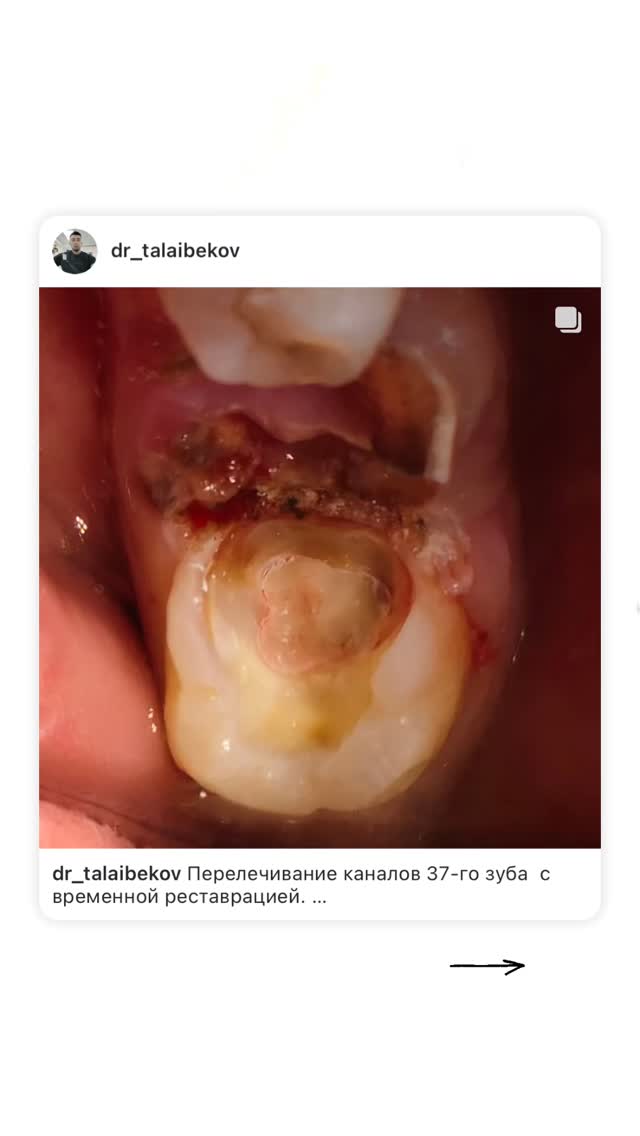Повторное эндодонтическое лечение