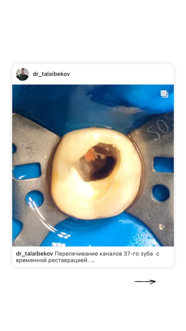 Эндодонтия — кейс 1