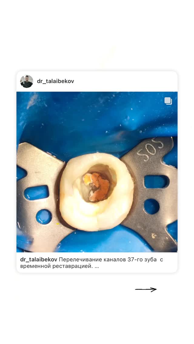 Эндодонтия — кейс 2