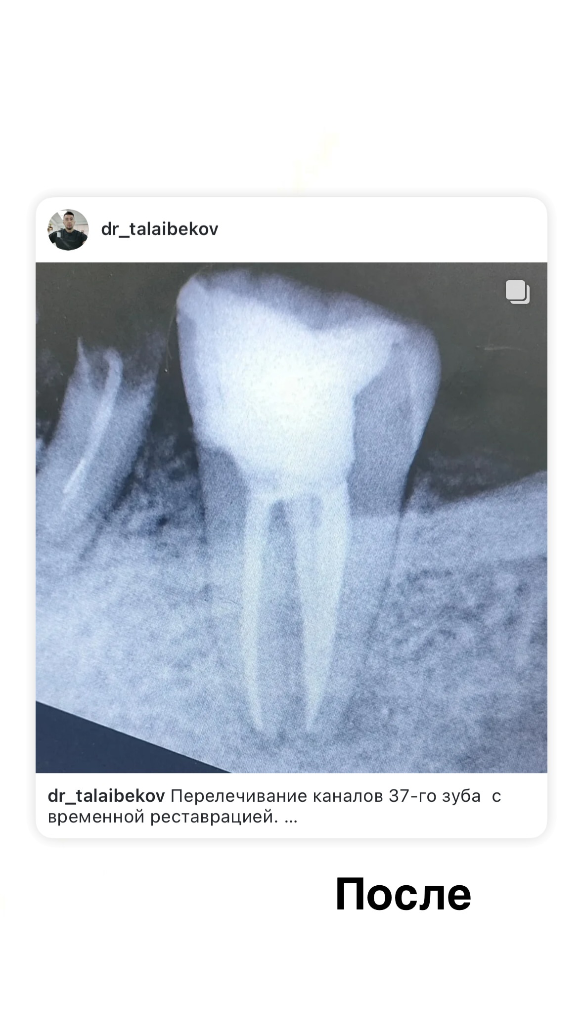Эндодонтия — кейс 3