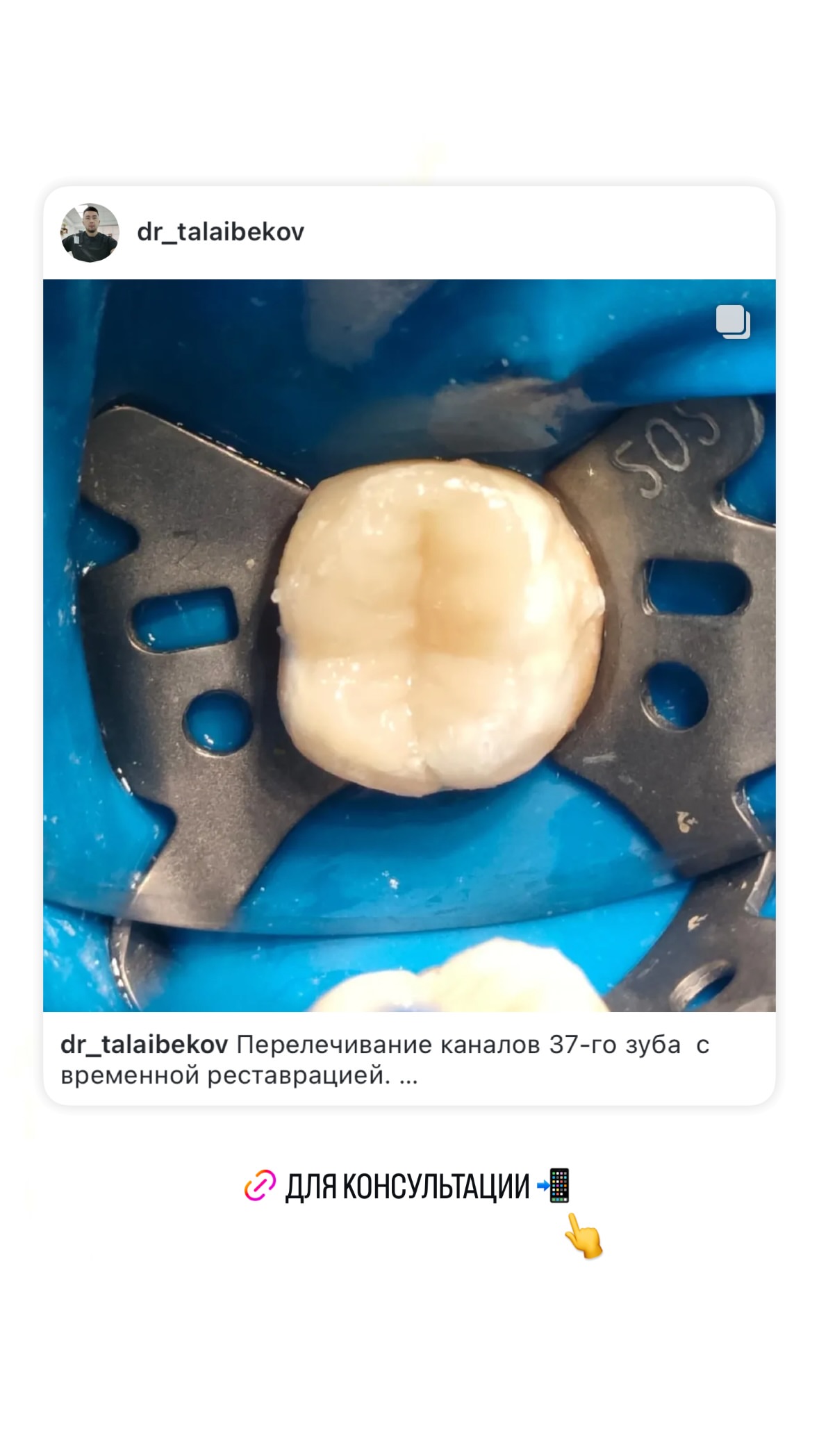 Эндодонтия — кейс 4