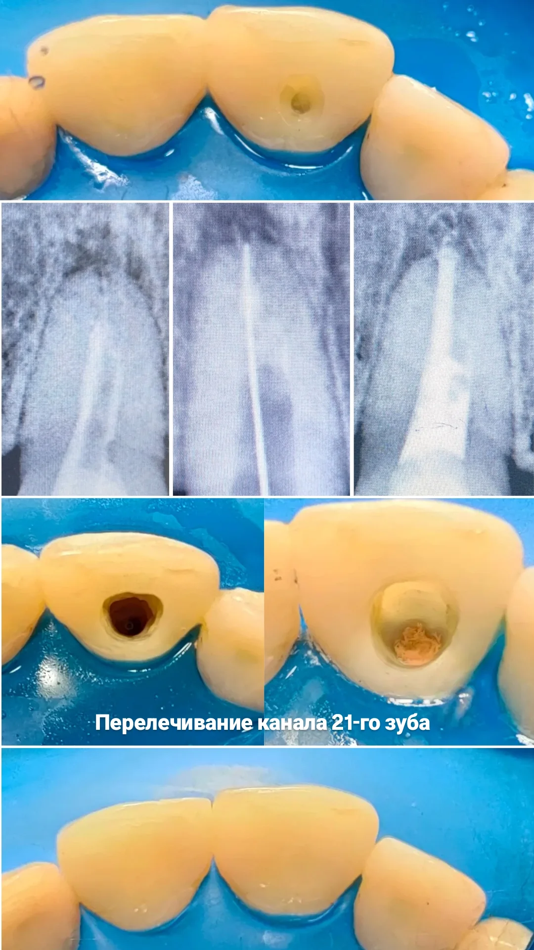 Эндодонтия — кейс 5