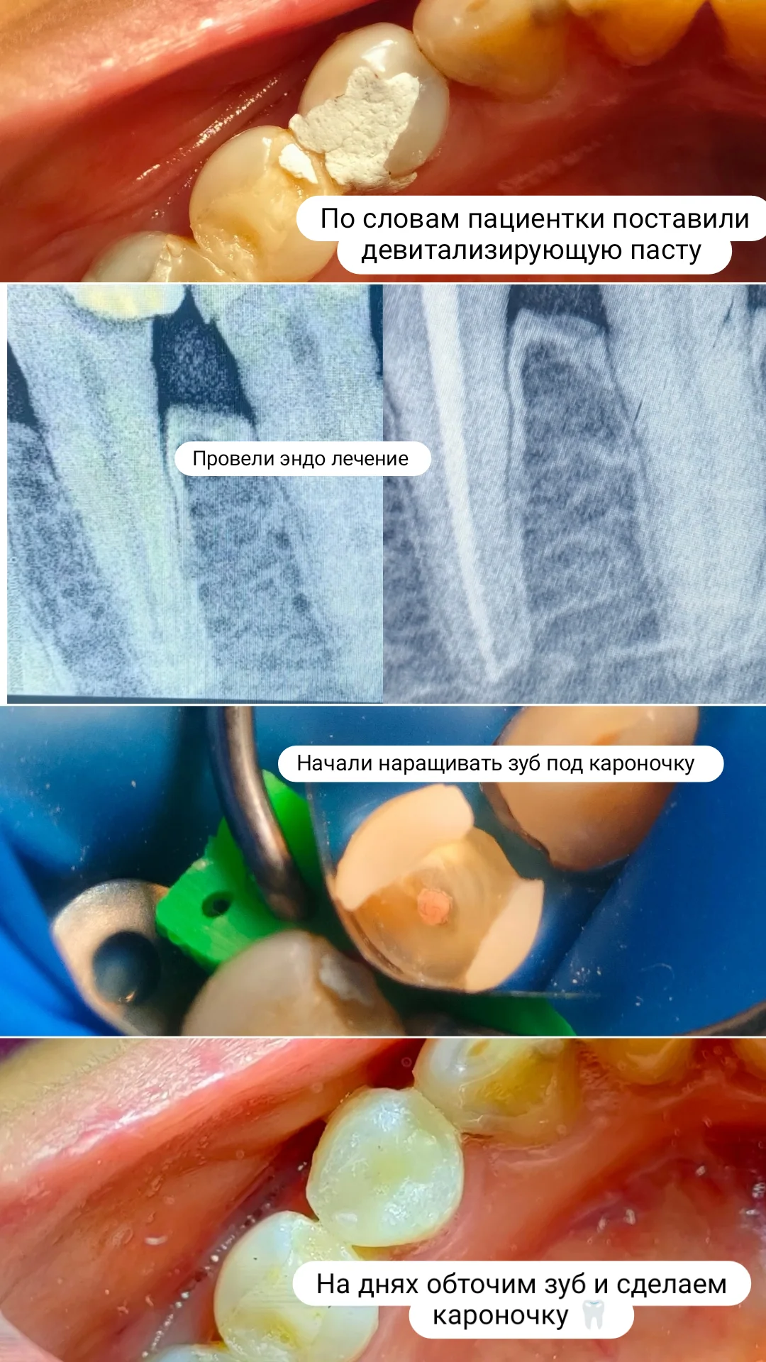 Эндодонтия — кейс 6