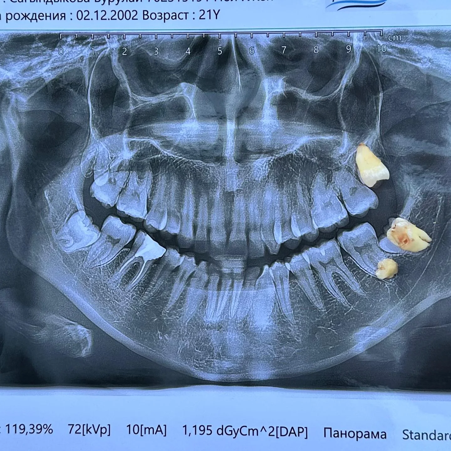 Удаление зубов мудрости